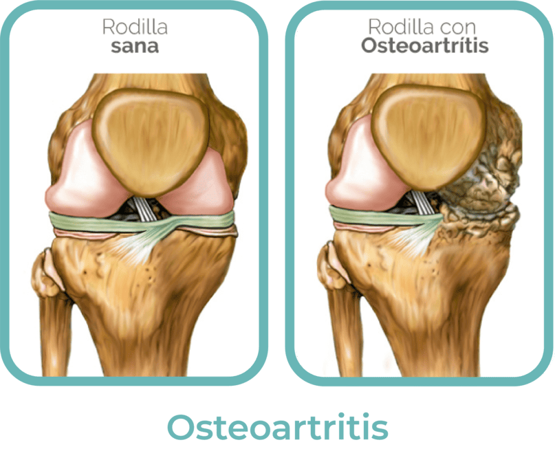 osteoartritis